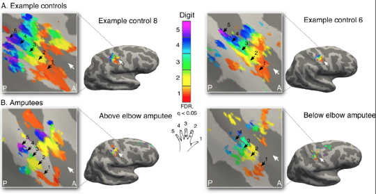 Brain imaging reveals detailed maps of the individual fingers of the hand in amputees (bottom) that are startling similar compared to the hand maps of the two-handed control participants (top). Author provided