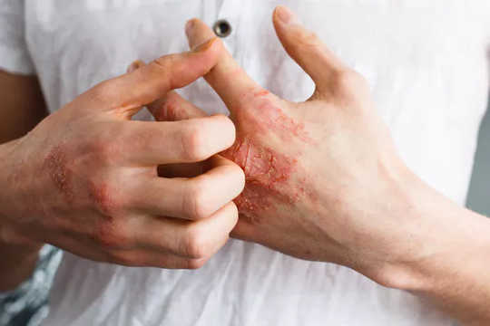 Skin conditions like eczema that break the surface of the skin are often associated with food allergies. (food allergies what you need to know about the role your skin plays)