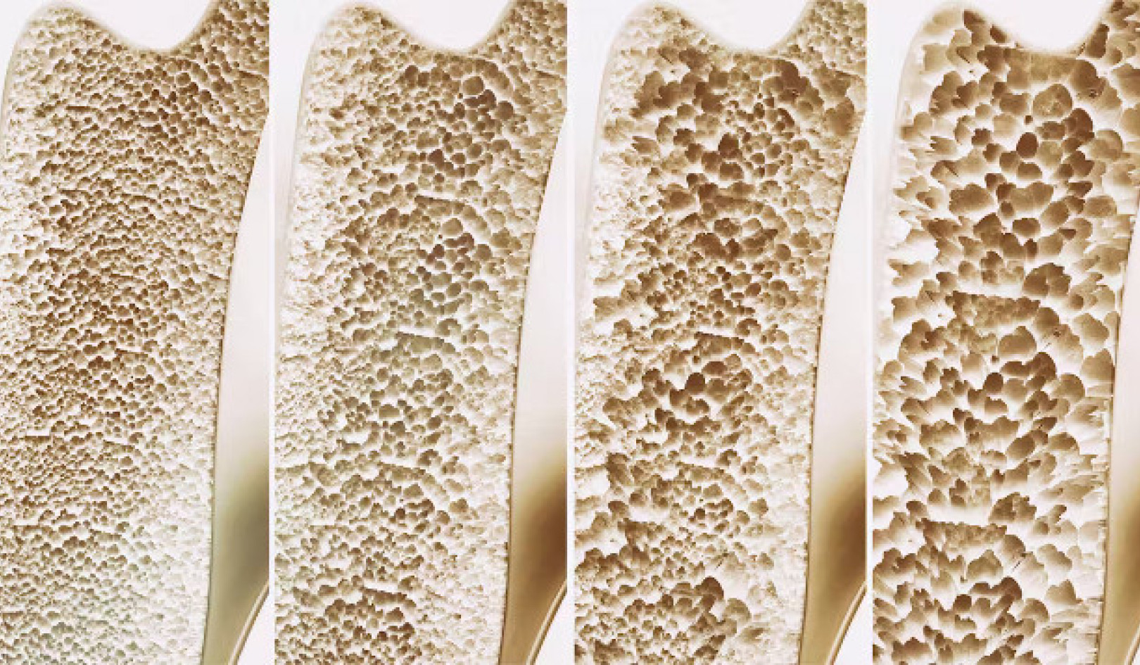 The Hidden Consequences of Extreme Dieting on Bone Density